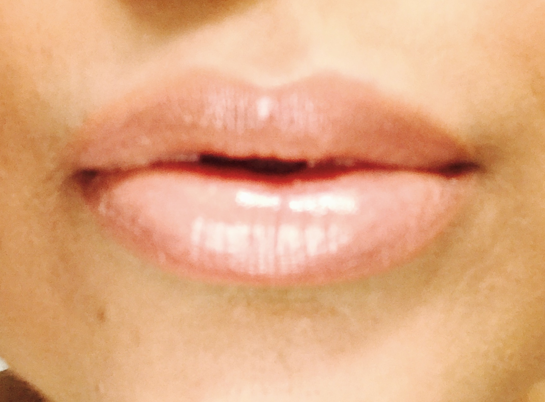 lip augmentation, lip injection, lip filler, kylie jenner lips